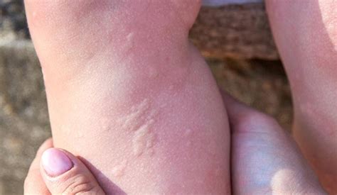 Cold Urticaria What It Is Symptoms Causes And Treatment