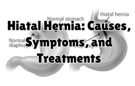 Gastroenterologists In Florida Hiatal Hernia Causes Symptoms And