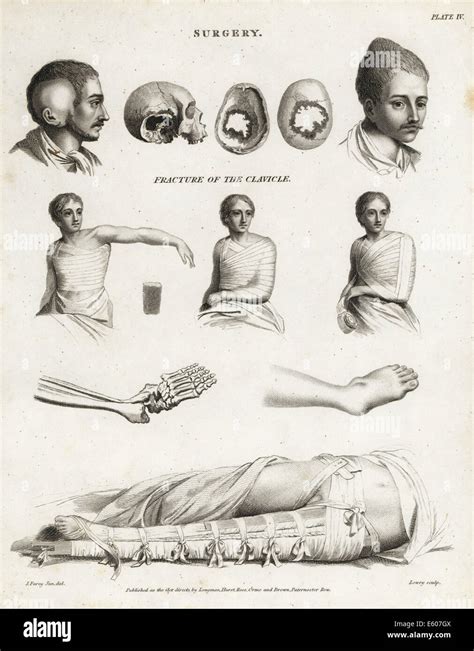Surgical Procedures From The 19th Century Stock Photo Alamy