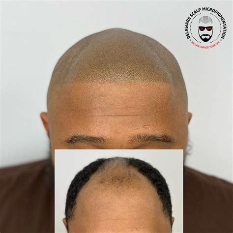 What Causes An Uneven Hairline And How Can I Fix It Delaware Scalp
