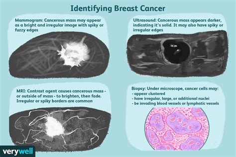 Breast Masses Cancerous Tumor Or Benign Lump