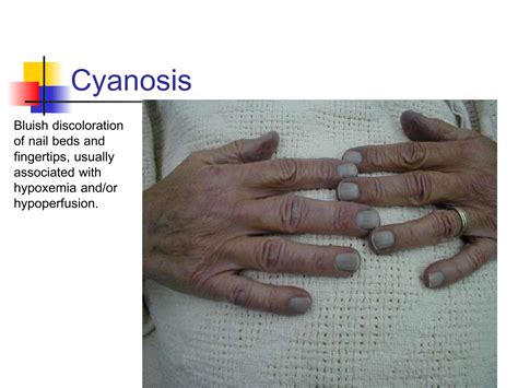 Solution Causes Of Central Cyanosis Signs And Symptoms Presentation