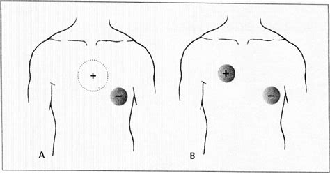 Figure 1 From Using Transcutaneous Cardiac Pacing To Best Advantage