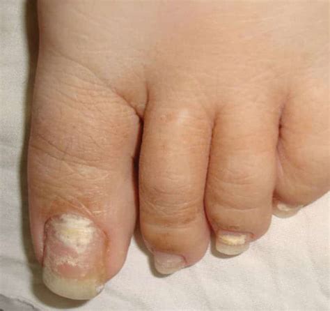 White Superficial Onychomycosis Types Symptoms Causes