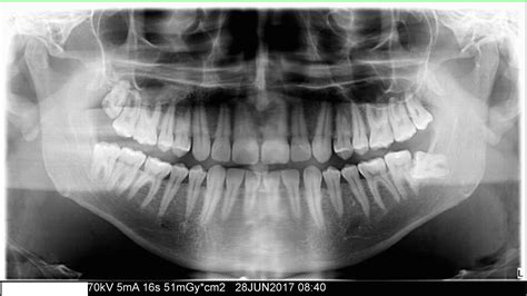 Risk Of Nerve Damage During Wisdom Tooth Extraction Dentistry