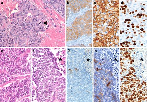 Histology Of Well And Poorly Differentiated Aggressive Neuroendocrine