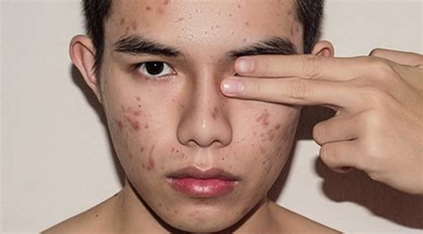 how to get rid of acne scars askmen