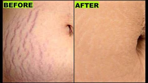How To Get Rid Of Stretch Marks In A Week Info Channel