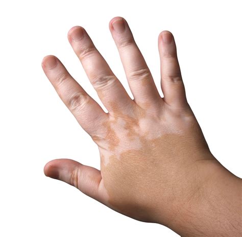 Vitiligo In Children Pictures 6 Photos And Images