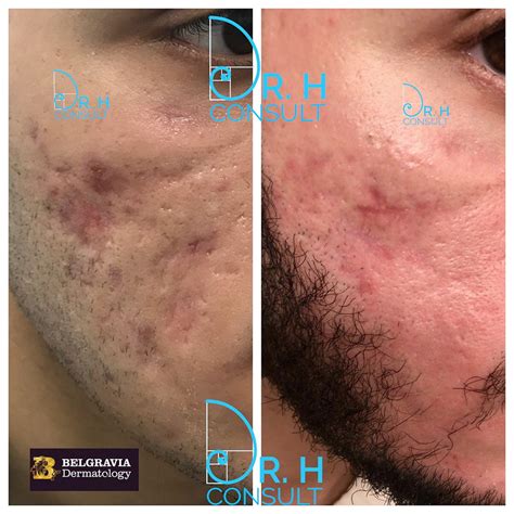 Acne Scar Laser Treatment And Removal London Dr H Consult