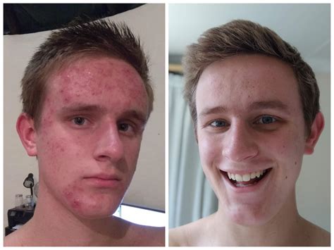 these two photos were taken 6 months apart it only took 3 months of accutane to make my face
