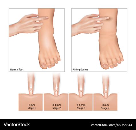 Pitting Edema And Normal Foot Oedema Fluid Vector Image