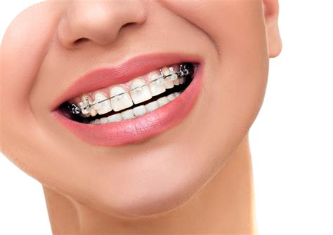 Ismile Dental Clinic Wagga Wagga Broken Braces And Wires