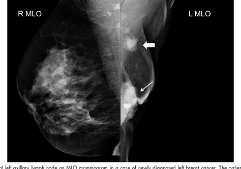Figure 2 From Imaging Axillary Lymph Nodes In Patients With Newly
