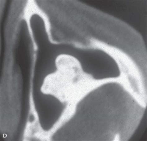 Benign And Malignant Osteogenic Tumors Of Bone Radiology Key