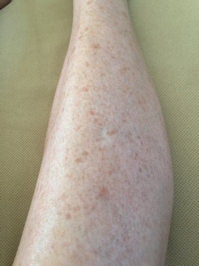 How To Get Rid Of Brown Sun Spots On Legs
