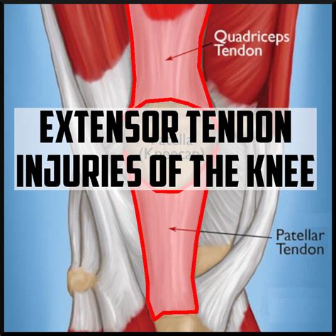 Extensor Tendon Injuries Of The Knee Sports Medicine Review