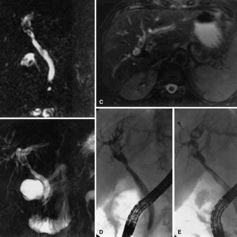 Anastomotic Biliary Stricture Balloon Dilation And Stenting A Erc