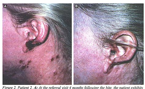 Figure From Brown Recluse Spider Bites To The Head Three Cases And A
