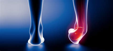 Sprained Ankle Diagnosis Treatment And Recovery