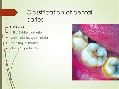 Black classification 14, a system developed in the dental caries might also appear in specific patterns, like for example the rampant caries, characterized by the appearance of points of decay on multiple. Dental caries and pulpitis - презентация онлайн
