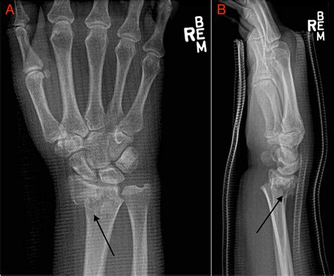 Cureus A Hematoma Block In The Wrist For A Displaced Distal Radius Fracture Induces Systemic