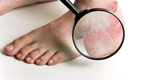 Tips For Managing Foot Psoriasis Everyday Health Psoriasis Remedies