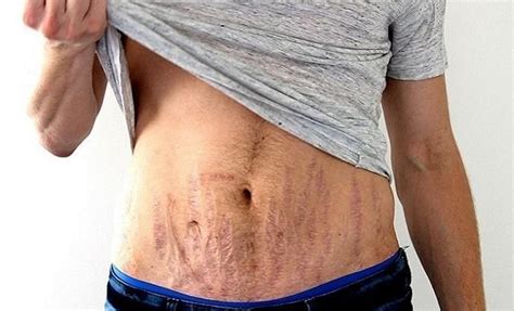 How To Get Rid Of Stretch Marks For Men Vitamincskincare
