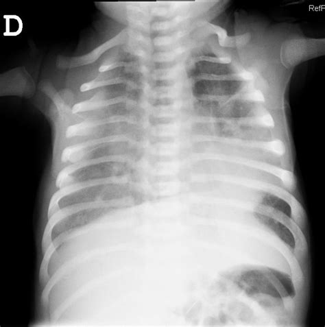 Imagen De Una Radiografia De Torax