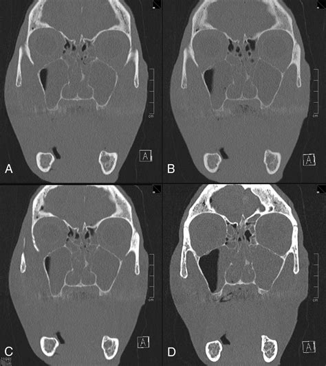 Imaging The Parasinus Region With A Third Generation Dual Source Ct And