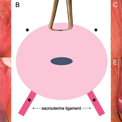 Visualization Of The Sacrouterine Ligaments By Pulling The Cervix