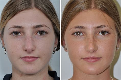 Rhinoplasty Before And After
