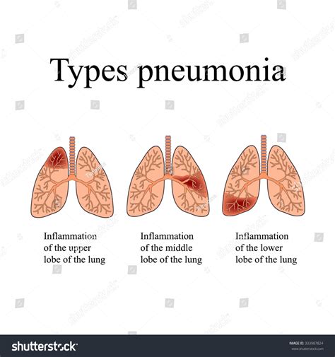 Pneumonia Anatomical Structure Human Lung Type Vector De Stock Libre