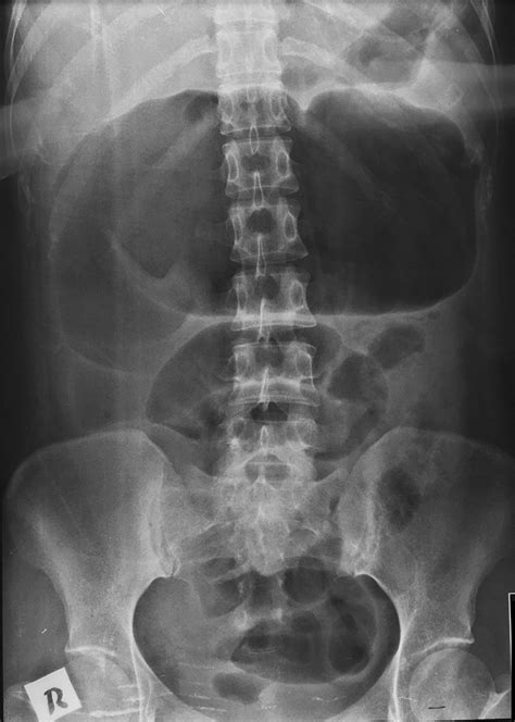Imaging Features Of Toxic Megacolon Bmj Case Reports