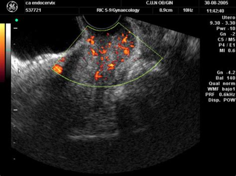 Transvaginal Color Doppler Ultrasound Showing A Cervica Open I