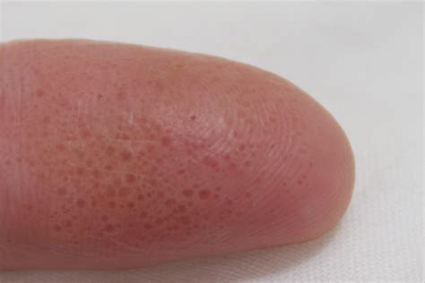 Is Eczema A Fungus Dorothee Padraig South West Skin Health Care