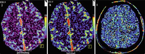 Demyelinating Diseases Radiology Key