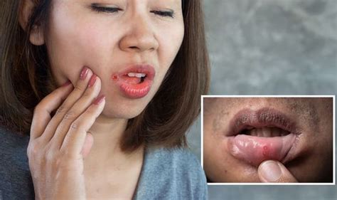 B12 Deficiency Ulcers And Pins And Needles In Tongue Are Symptoms