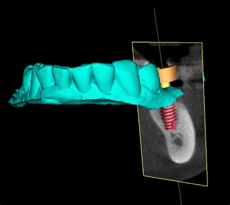 Digital Implantology Guided Surgery 3d Printing Teeth And Titanium
