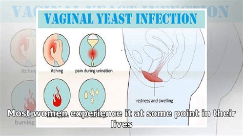 Vaginal Itching Causessymptomshome Remedies And Treatment Youtube