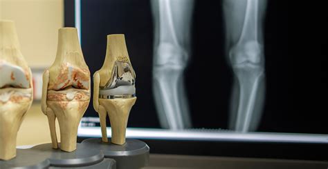 Advanced Total Knee Replacement Surgery In India At Affordable Rates News Media Blog