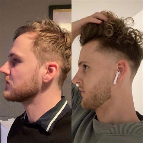 Two Years of 1mg Daily Finasteride and 2x weekly microneedling. : r