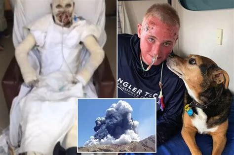 White Island Volcano Survivor Shows Horror 70 Burns After Dad And