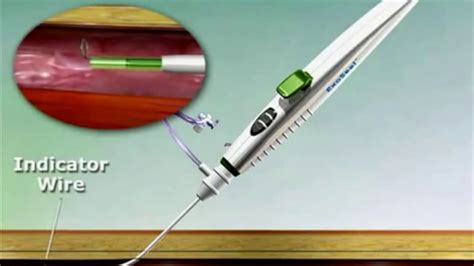 Exoseal Femoral Access Vascular Closure Device Youtube