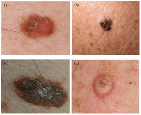 Rash is a general term for skin lesions, but it is not specific enough for a diagnosis. Four examples of skin lesions: (a) dysplastic nevus, (b ...