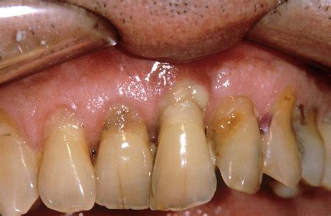 Abscess In Severe Gum Disease Photograph By Dr Jp Casteydecnri