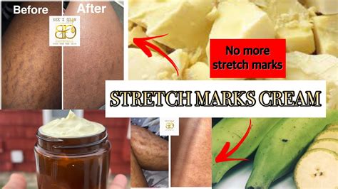 How To Make Stretch Marks Cream Get Rid Of Stretch Marks And Scars