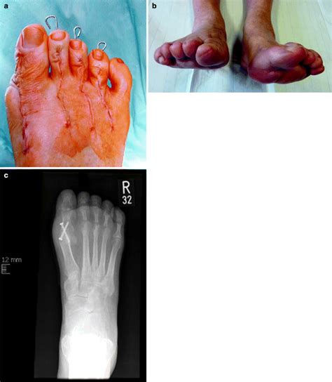 Surgical Treatment Of Hammer Toe Claw Toe And Mallet Toe Deformity