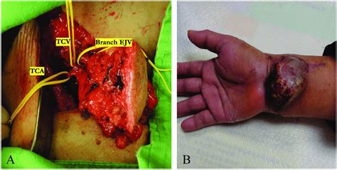 Case Of A Supraclavicular Vascularized Lymph Node Transfer Vlnt A