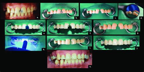 Clinical Photographs Illustrating The Steps Of The Restoration Of 11